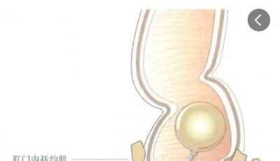 TPE材质球囊在直肠测压术中的应用与优势